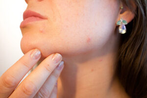 Read more about the article What Foods Help Clear Acne: A Skin-Saving Diet