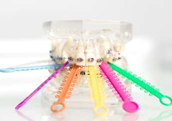 Read more about the article List of Foods You Cant Eat With Braces | What to Eat Instead